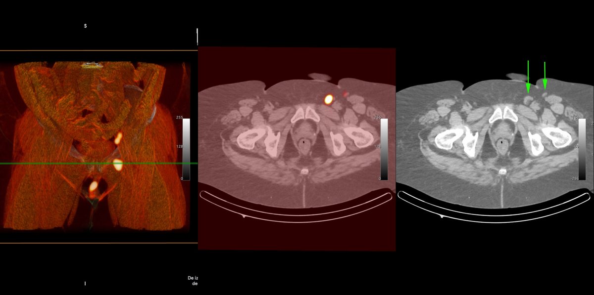 IAEANA's tweet image. 🔬New CRP: @iaeaorg is launching a new research project on the use of sentinel node biopsy (SNB) for vulvar and cervical cancers. 🏥
Details & how to join⬇️
tinyurl.com/mr3auj4x
#callforproposals #CancerResearch