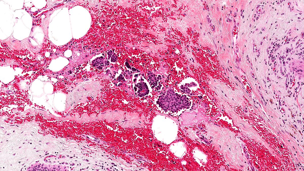 Case of Blade Drag 🔬

Grossing blades can dislodge and drag tumor cells across the cut surface, creating artifacts that mimic invasion (👇) or falsely involve margins—especially in papillary tumors.

#PathX #PathTwitter #breastpath