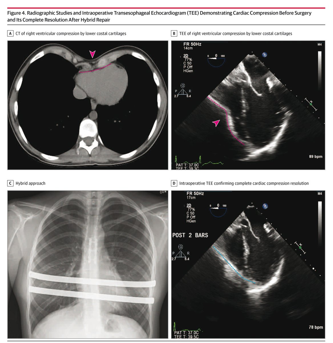 JAMASurgery's tweet image. Systematic review: Pectus arcuatum, a rare chest wall deformity distinct from other pectus types, requires standardized diagnostic criteria and unified terminology. ja.ma/4l2DIKI