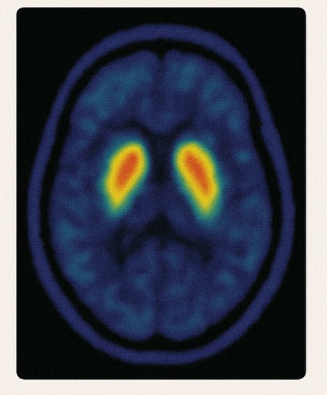 ParkinsonismD's tweet image. Comparative diagnostic efficacy of neuromelanin MRI vs. dopamine transporter (DAT) imaging in Parkinson's disease: A systematic review
#neuromelaninMRI #DAT #dopaminetransporter #Parkinson #systemicreview
@PRDAssociation
Log in:
prd-journal.com/article/S1353-…