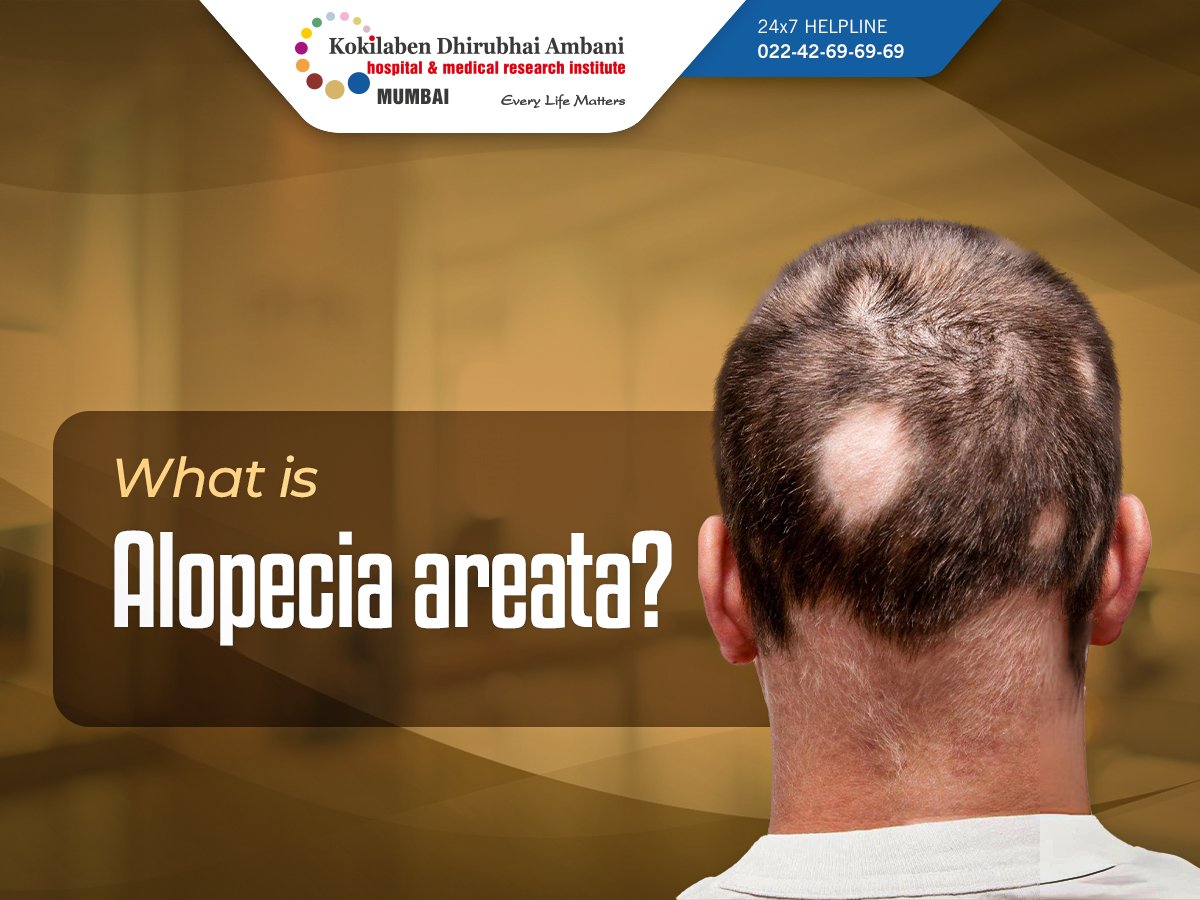 Sudden patchy hair loss can be alarming, and it might be more than just stress. It could be Alopecia Areata, an autoimmune condition where your body’s immune system mistakenly attacks healthy hair follicles, causing hair to fall out in smooth, round patches. This can affect the