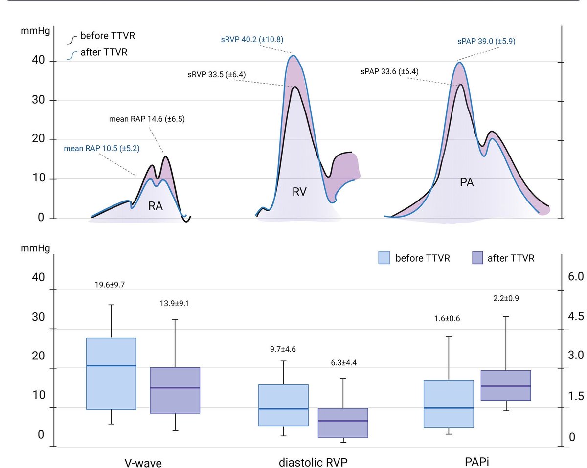 DomAngellotti's tweet image. Are you performing right cath after TTVR?
EJHF: First insights into the impact of TR elimination on right heart:
Immediate RAP reduction ⬇️
Increased systolic RV/PA pressure⬆️ and PAPi ⬆️
Data From Bern by Fabien Praz
🔗 doi.org/10.1002/ejhf.3…
@EJHFEiC #CardioTwitter