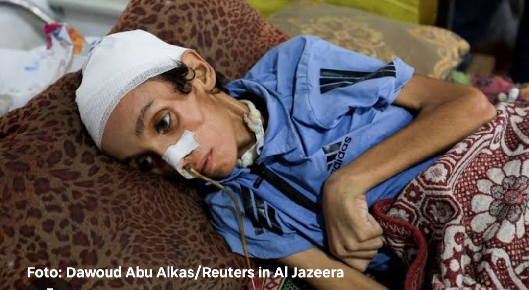 christian_leye's tweet image. So sieht die Belagerung des Gaza-Streifen aus: der 14-jährige Mosab al-Debs im al-Shifa Hospital.
Dass die deutsche Regierung sich weigert einen Appell zu unterzeichnen, ist eine Schande. Irgendwann werden unsere Kinder fragen, für wen F. Merz "die Drecksarbeit erledigt hat".
