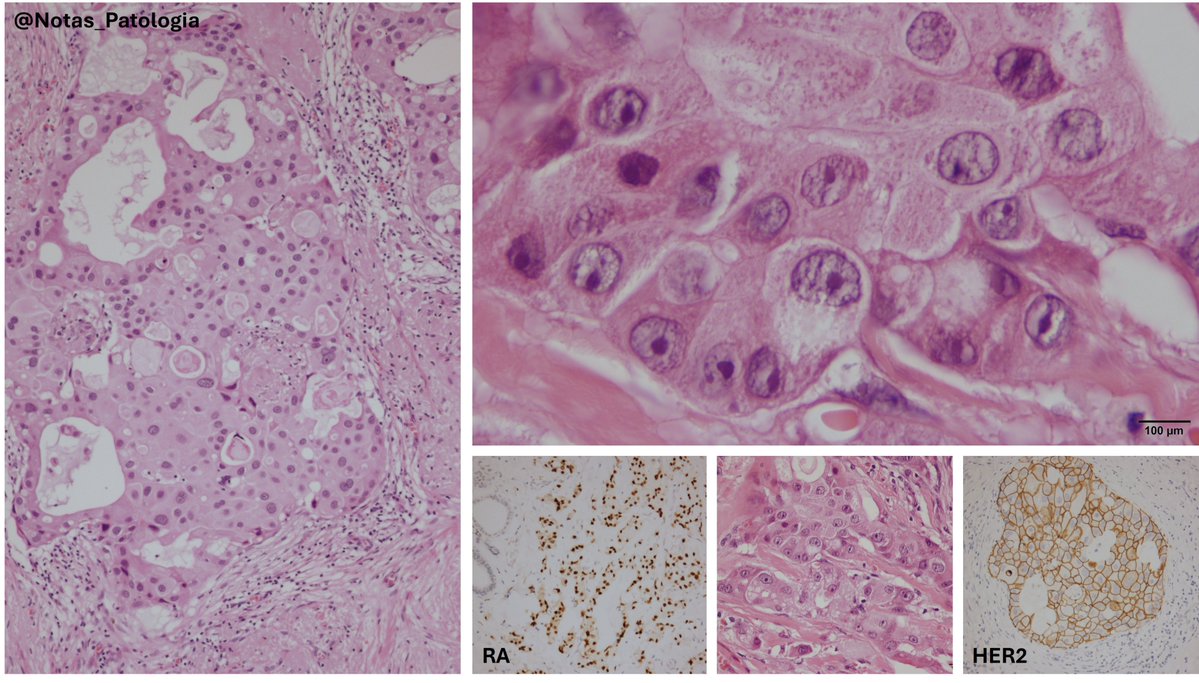 🧬 APOCRINE CARCINOMA OF THE BREAST: A DISTINCT AND RARE SUBTYPE

Carcinoma with apocrine differentiation is a rare form of invasive breast cancer, accounting for approximately 1% of cases. It is characterized by large cells with abundant eosinophilic granular cytoplasm, enlarged