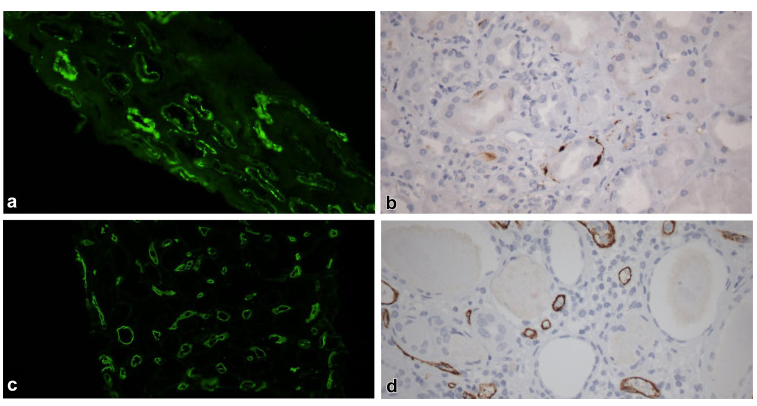KIReports's tweet photo. #Complement Activation in #BK Polyoma Virus #Nephropathy: What’s the Story?
https://t.co/qGiJvld2D7
Original Article: https://t.co/ogVi37ADQ1
#KIRCommentary https://t.co/JewWDTm0s7