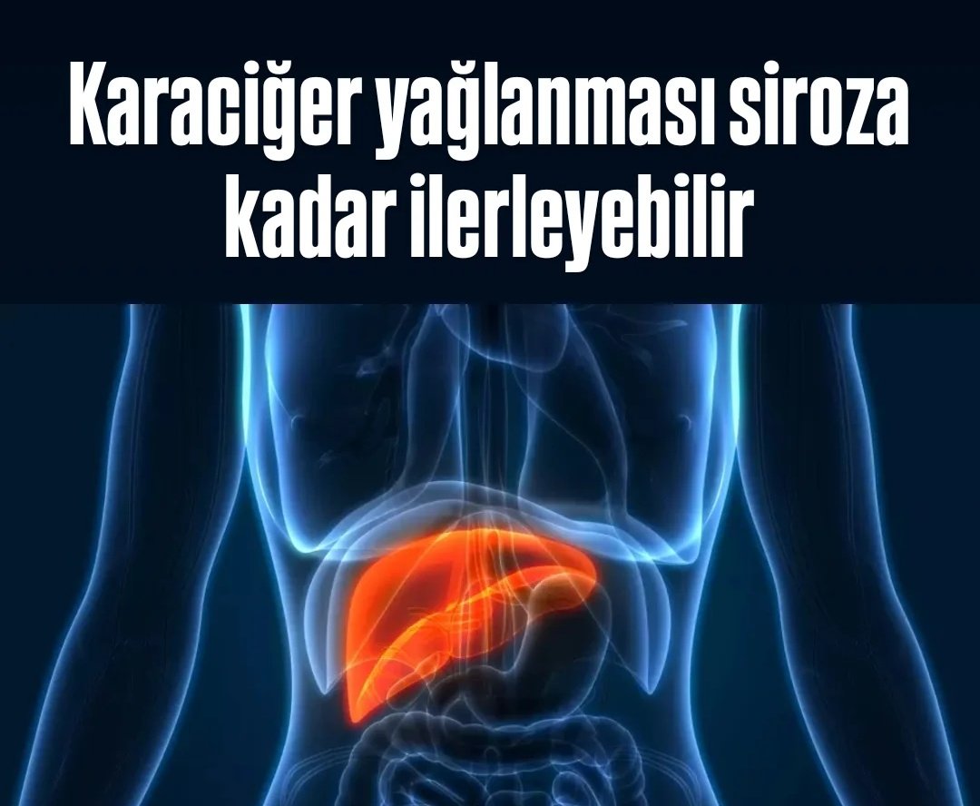 Karaciğer yağlanması siroza kadar ilerleyebilir

bursayasam.com.tr/karaciger-yagl…