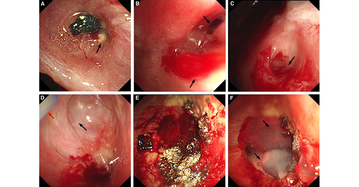 ATSBlueEditor's tweet image. Argon Plasma Coagulation Combined with Human Fibrin Sealant under Medical Thoracoscopy in the Closure of Bronchopleural Fistula

The authors suggest that medical thoracoscopy has strong potential for the treatment of bronchopleural fistula

🔗 tinyurl.com/9avmsca7