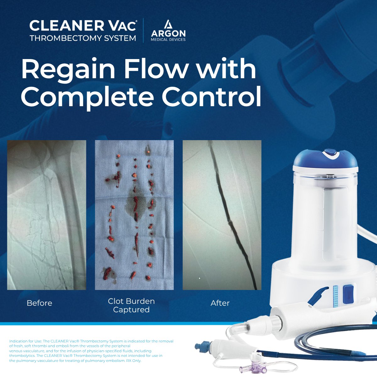 ArgonMedical's tweet image. The CLEANER Vac® 18F Thrombectomy System delivers powerful performance with on-demand pulse aspiration, providing precise control and efficient clot removal—as seen in this case with Dr. Ilan Rzadkowolsky-Raoli.
“The powerful aspiration of the CLEANER Vac allowed me to remove…