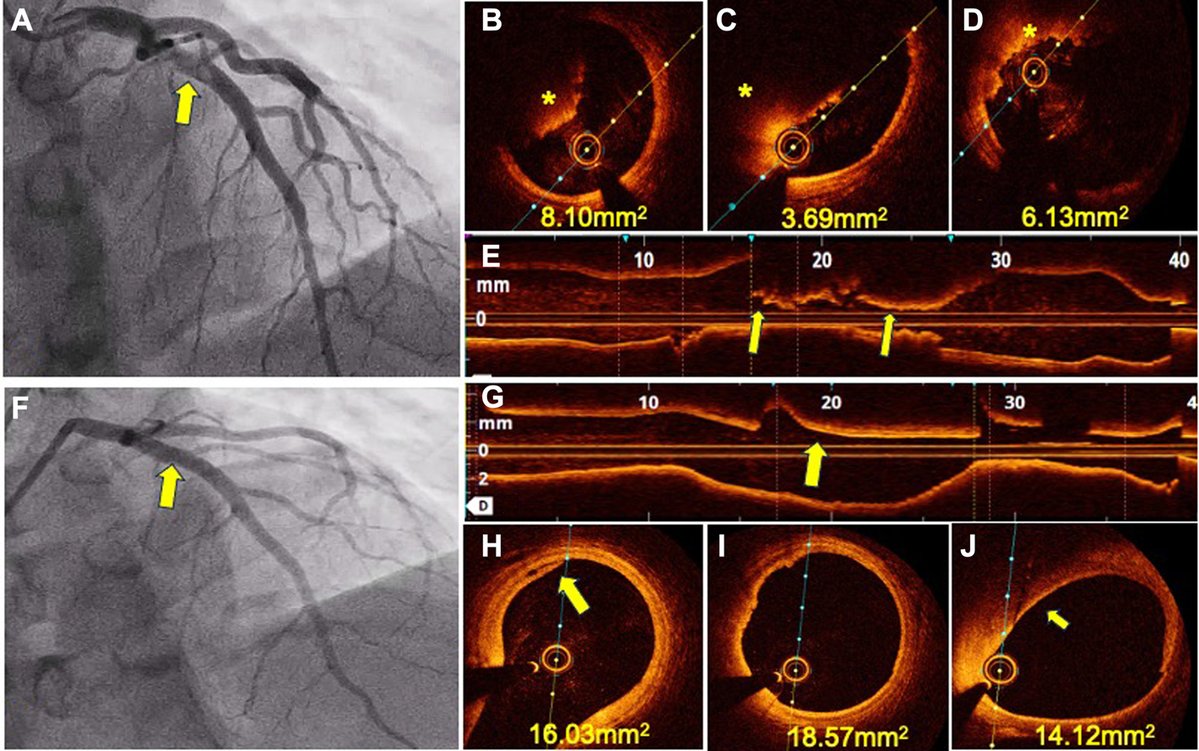 JACCJournals's tweet image. Many times, young patients w/ #STEMI are angina free during primary #PCI &amp;amp; have patent infarct-related artery w/ TIMI flow grade 3 due to the process of autolysis. This #JACCCaseReports case series provides a new perspective to the mgmt of such patients jacc.org/doi/10.1016/j.…
