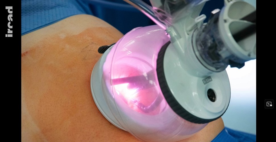websurg's tweet image. Robotic single port Toupet fundoplication: implementation of the da Vinci SP system in the treatment of gastroesophageal reflux disease (GERD)
👉 Watch here: irc.ad/F0zC
#robotic #surgery #minimallyinvasive #uppergi #fundoplication