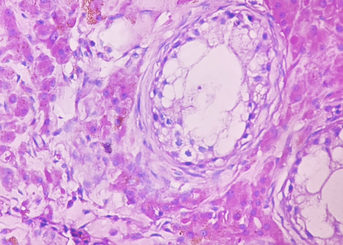 Histopathologic changes in cryptorchid testis in 71 years old man demonstrating atrophic hyalinized seminiferous tubules with thick basement without spermatogenesis, interstitial fibrosis and Leydig cell hyperplasia.
#pathology #GUPath #Cryptorchidism