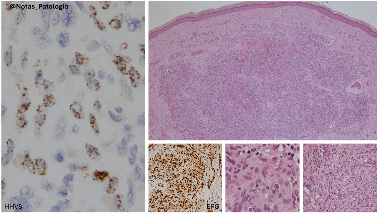 🦠 KAPOSI SARCOMA (KS): AN HHV8-ASSOCIATED VASCULAR NEOPLASM

Kaposi sarcoma (KS) is a locally aggressive vascular proliferation caused by human herpesvirus 8 (HHV8). It typically presents with multiple purplish cutaneous lesions, but may also involve mucosal surfaces, lymph