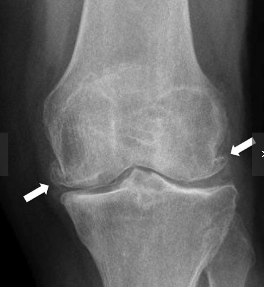 KoneruMd's tweet image. 67 yo with significant right knee pain (7/10) with walking. X-Ray confirms KL grade 3 osteoarthritis. Arrows point to osteophyte formation and joint space narrowing. He has failed conservative management with exercise, weight loss and physical therapy. He has also tried NSAIDs…