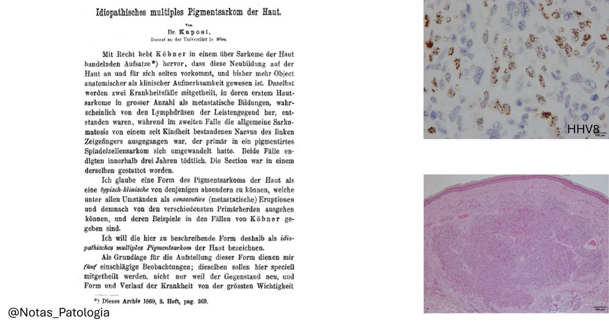 🧑‍⚕️ WHO WAS MORITZ KAPOSI?

Ever wondered who gave the name to Kaposi sarcoma?

🎩 Moritz Kaposi (1837–1902) was a Hungarian physician and one of the founders of modern dermatopathology. Born Moritz Kohn, he later changed his surname to Kaposi (after his hometown Kaposvár,