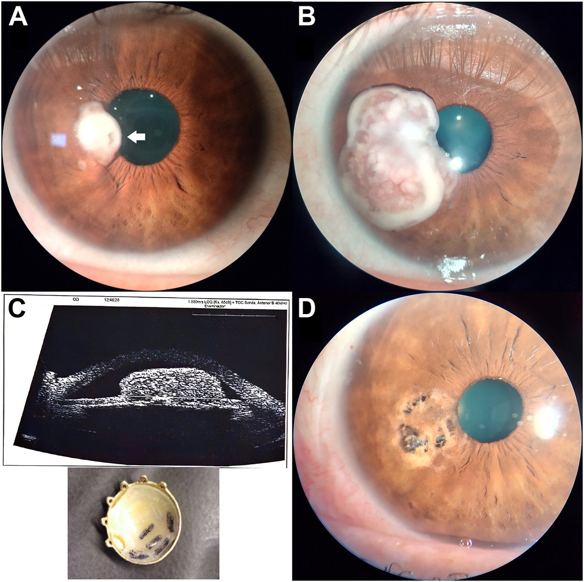 AAOjournal's tweet image. Iris Metastasis as Presenting Feature of Uterine Cervix Cancer
ow.ly/4ECo50WcVG5
#ophthalmology