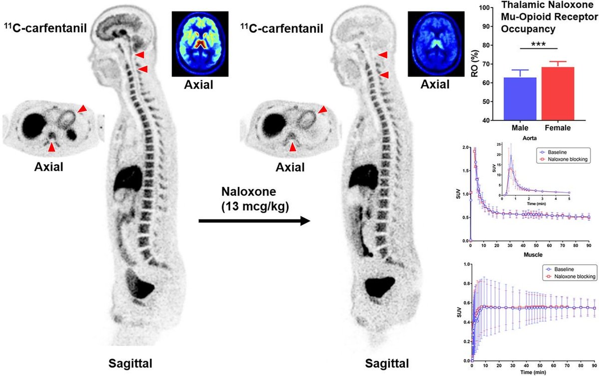 A new study using whole-body PET to assess naloxone’s (also known as Narcan) binding to opioid receptors suggests that men and women respond differently to opioid use disorder treatments.