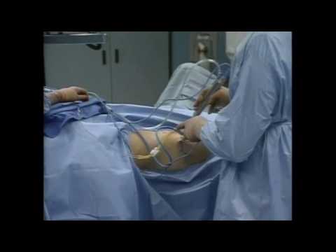 Nashville Hip Institute at TOA (@nashvilleorthos) on Twitter photo #TBT: This video captures the case that changed #hip #arthroscopy forever. Dr Byrd faced a 14-year hip mystery.
▪️The cause? A massive labral tear flipped into the joint.
▪️The result? Resolution — and a new era in hip care.
  Watch the story unfold 👉 medilink.us/51sz #TBT: This video captures the case that changed #hip #arthroscopy forever. Dr Byrd faced a 14-year hip mystery.
▪️The cause? A massive labral tear flipped into the joint.
▪️The result? Resolution — and a new era in hip care.
  Watch the story unfold 👉 medilink.us/51sz