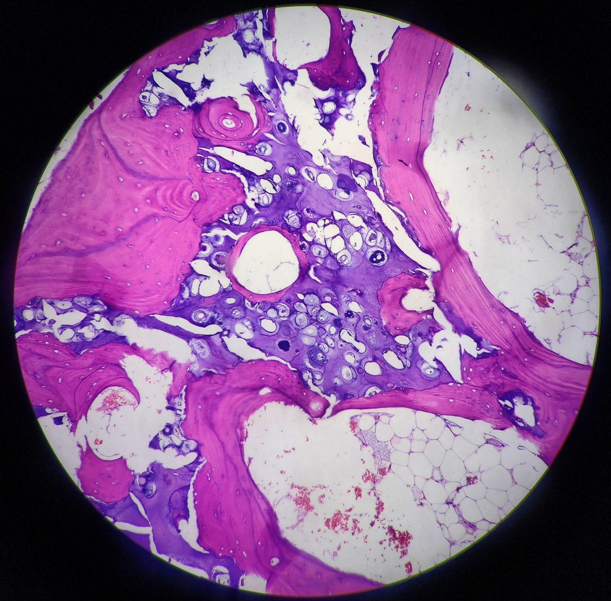 #histopathology 
#bone
#pathX
#pathTwitter
Gross and photomicrographs.
Dx: Chondrosarcoma.