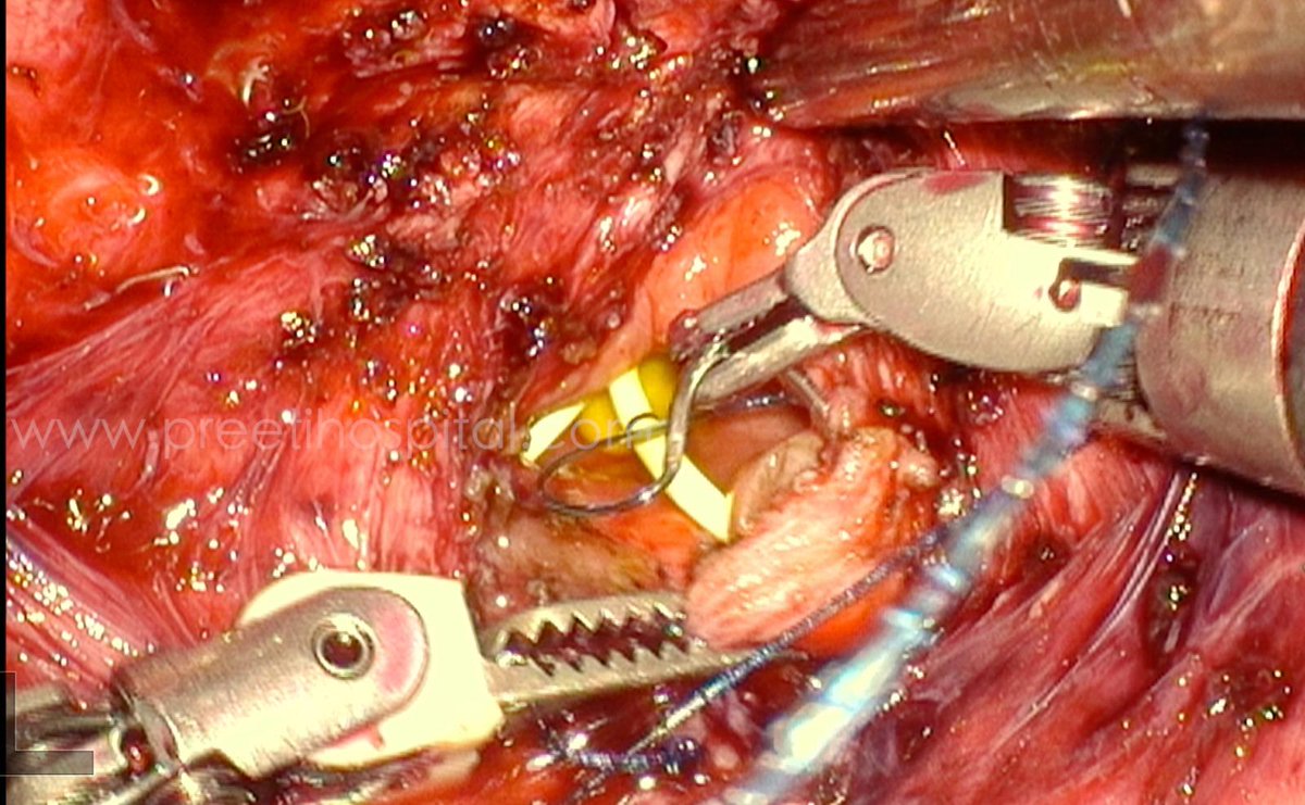 youtu.be/jRU0Fjr4Jo8
A 32-year-old woman presented with a low-lying vesicovaginal fistula near the ureteric orifice following a cesarean section.
 ROBOTIC VVF repair was performed without the need for ureteric reimplantation.  Two sutures were placed close to the ureteric