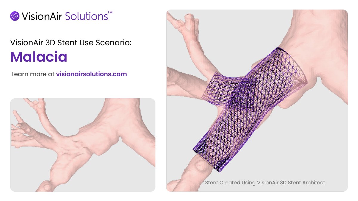 #TransplantTuesday

Malacic. Complicated. Post-transplant.

No problem.

With the V3D software, stents don’t just fit in the airway... they match the airway!

#3DStent #PatientSpecific #Malacia