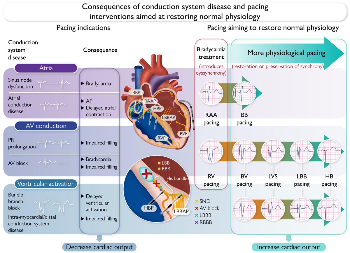 ehj_ed's tweet image. Physiological pacing: mechanisms, clinical indications, and perspectives.
Read this State-of-the-Art review just published in #EHJ
academic.oup.com/eurheartj/adva…
@escardio @ESC_Journals