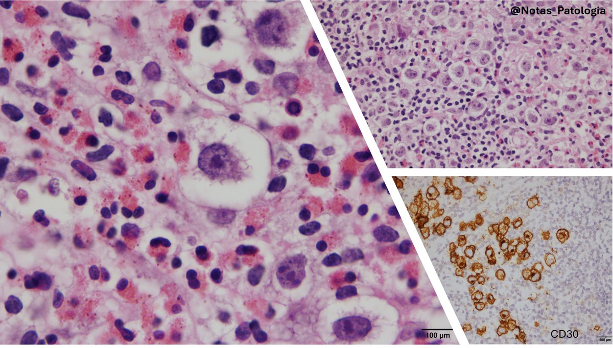 🩸 CLASSICAL HODGKIN LYMPHOMA (CHL)

🧬 Definition
A neoplasm derived from germinal center B cells, characterized by a low proportion of neoplastic cells (Hodgkin and Reed–Sternberg cells) within a reactive microenvironment rich in lymphocytes, histiocytes, and eosinophils.

📍