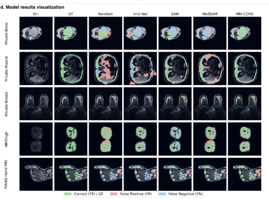 AmineKorchiMD's tweet image. Duke team just released MRI-CORE: A Foundation Model for Magnetic Resonance Imaging, trained on + 6 million slices from + 110’000 MRI volumes across 18 body locations. 🚀
Link : arxiv.org/abs/2506.12186
#radiology #AI #MRI