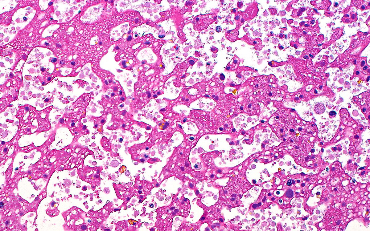 ziad_zaatari's tweet image. 🔬📷 Seminal Vesicle Secretions ~ #GUpath #Pathology #Histology #PathArt 🎨