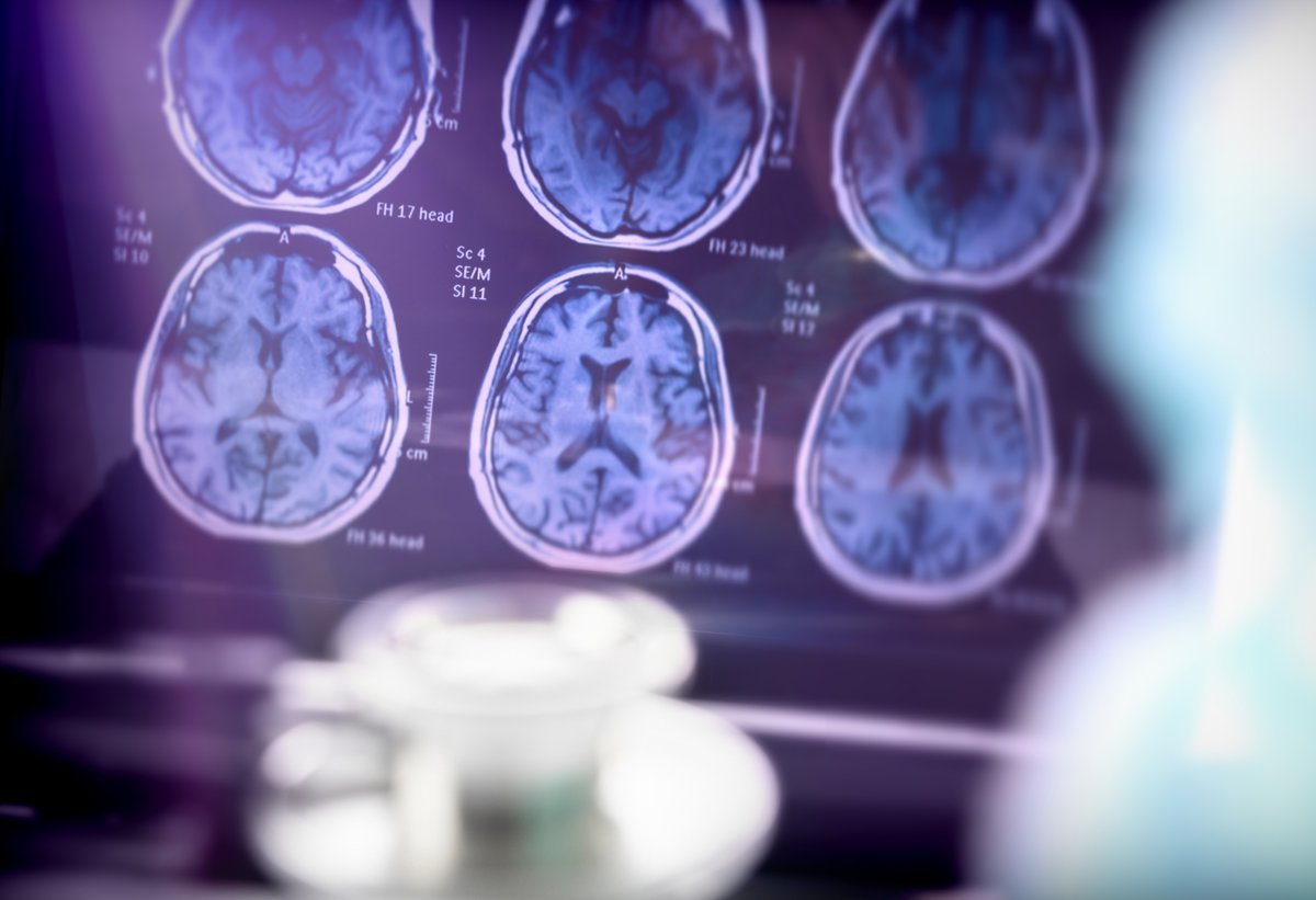 TheADDF's tweet image. Ahead of #AAIC2025, @a_fillit shares how patients now have access to new treatments in the U.S, yet the regulatory approvals in Europe face delays. Alzheimer's has entered a new era and now is the time to invest in scalable, cost-effective treatments.
bit.ly/3GIBfXH