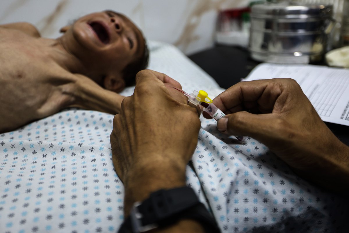 HananBalkhy's tweet image. #Gaza is starving, putting people at risk, alongside bombs and bullets.
Severe acute malnutrition centres are full, with only limited supplies remaining for treatment.
@WHO has documented 21 deaths related to malnutrition of children under five-years-old in 2025. Over 20 percent…