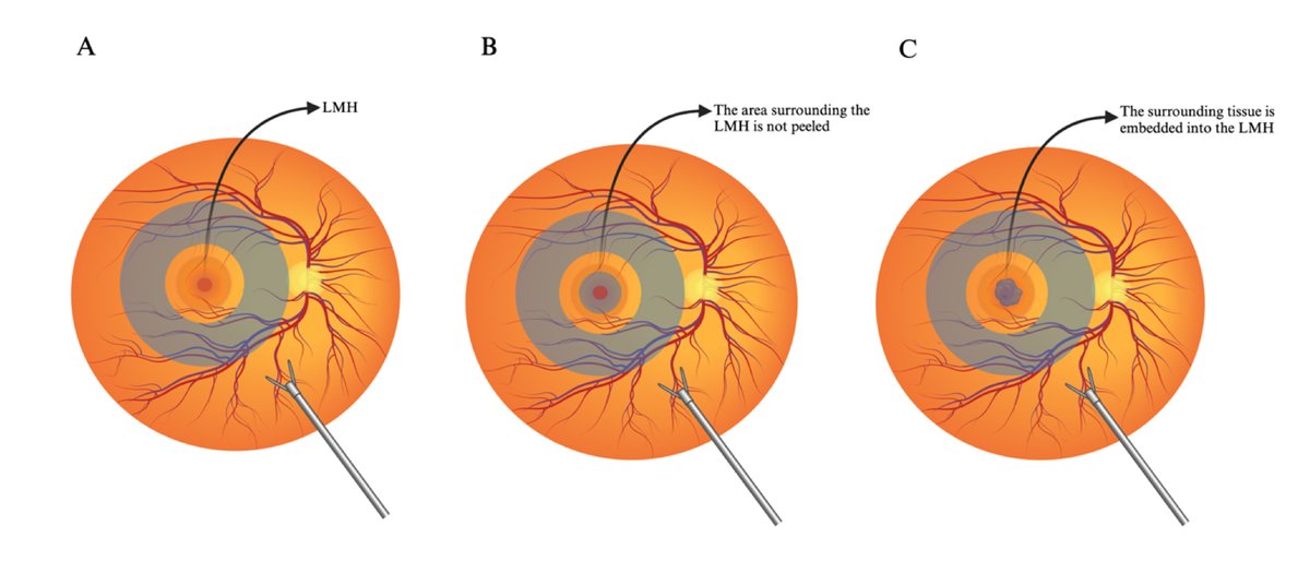Comparing Membrane Peeling Techniques in Lamellar Macular Hole Surgery: A Systematic Review and Meta-Analysis
ow.ly/P9i550Wikc0
#ophthalmology #retina