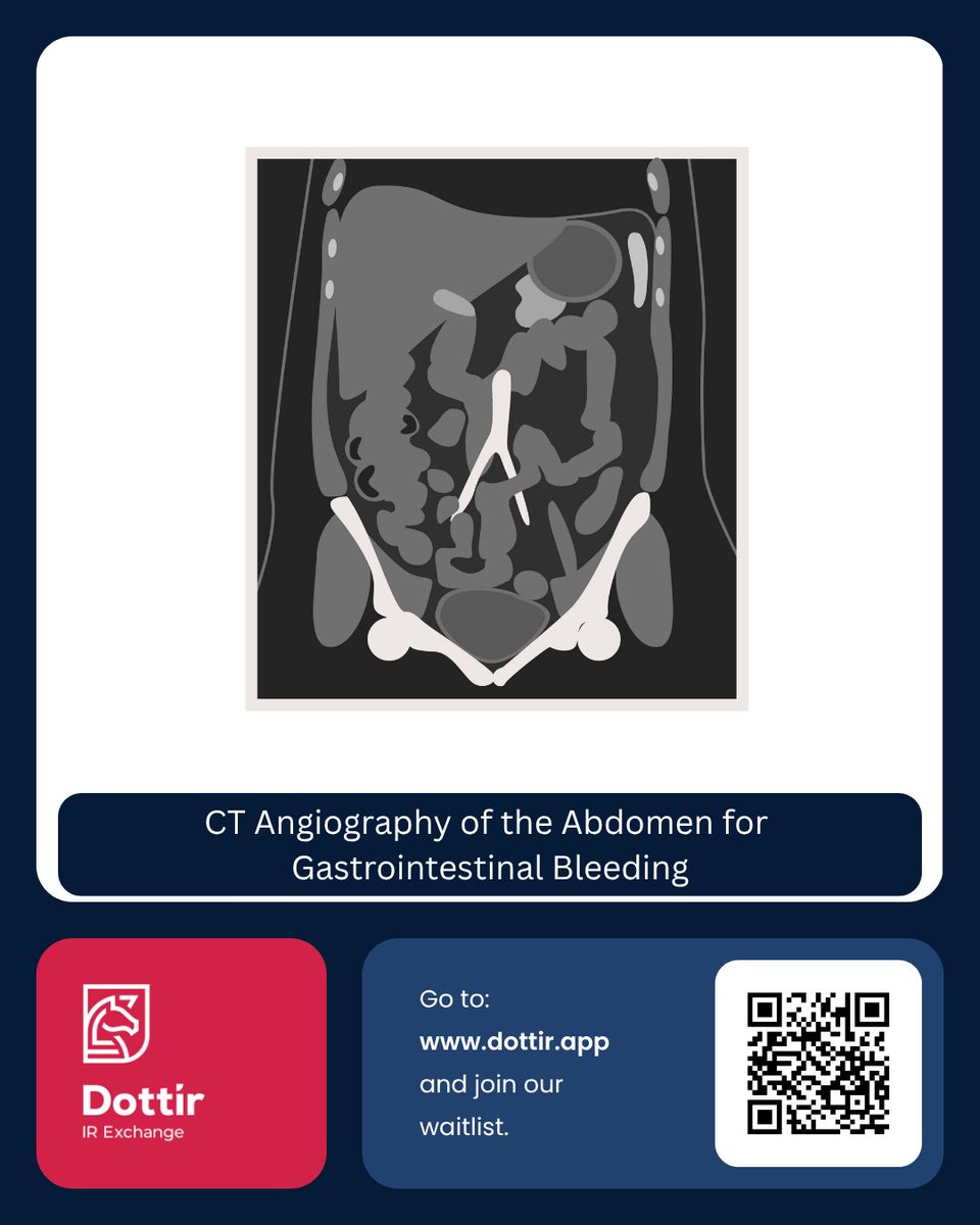 CT angiography helps localise GI bleeds, assess vessels, and guide embolisation especially when endoscopy fails. Fast, non-invasive, and crucial in acute GI bleed workup.
#Dottir #CTAngiography #GIbleed #Embolisation #Endoscopy