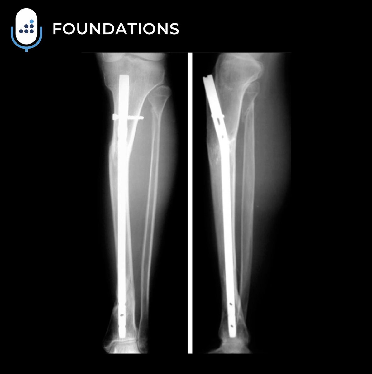 orthobullets's tweet image. Welcome to Season 2 of the Orthobullets Podcast
Today's Foundations episode will focus on the topic of Proximal Third Tibia Fracture.
Proximal third tibia fractures are common and often involve soft tissue damage and risk of malunion, typically in valgus and procurvatum.…