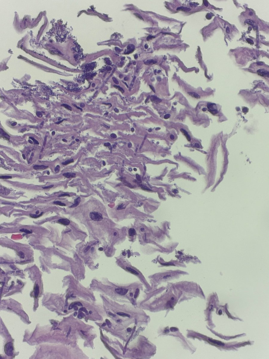 Esophageal candidiasis: brought to you by the shredded wheat sign.

Save the IHC for brunch. 🌾

#GIpath #PathX #pathagonia