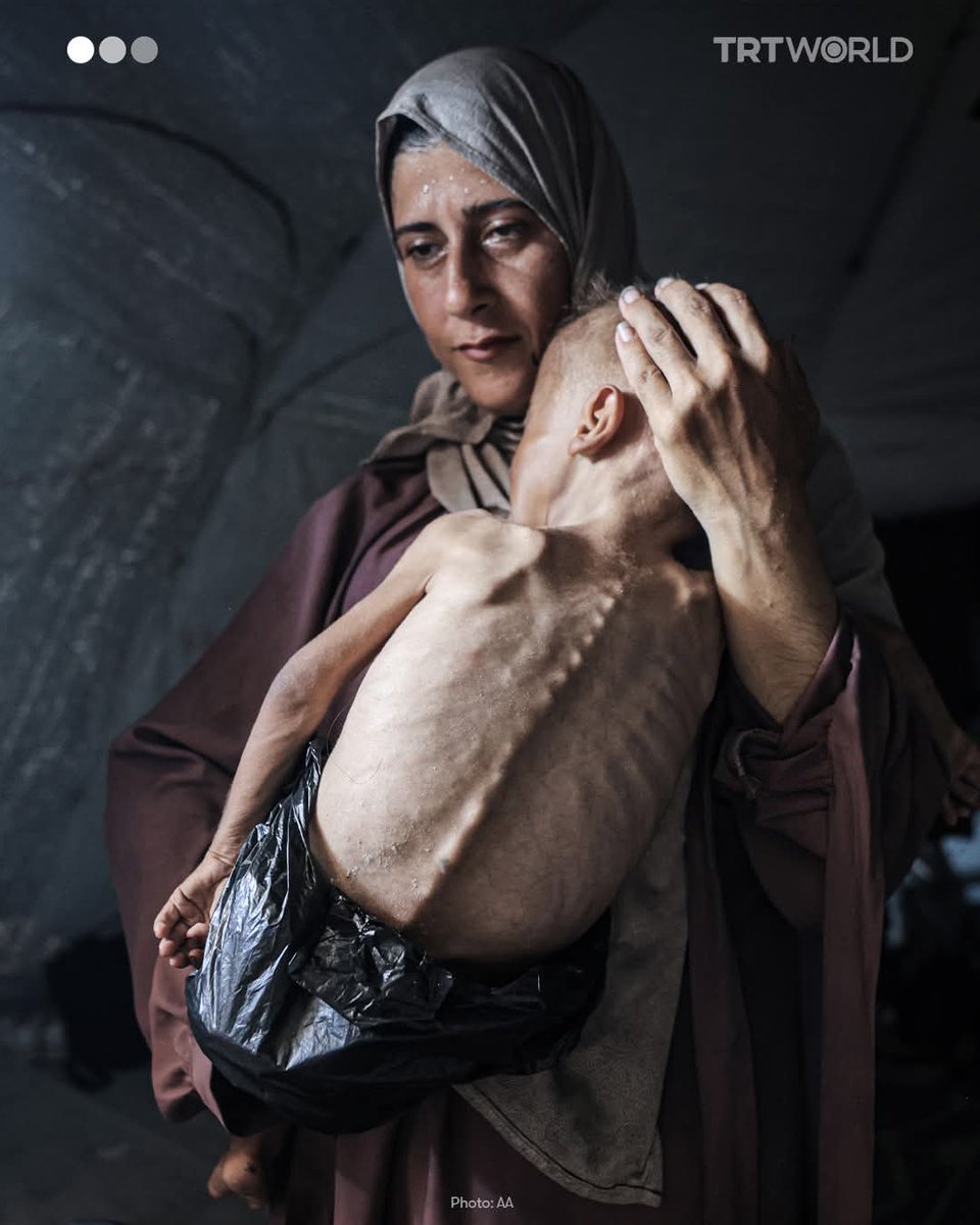 MuradTadesse's tweet photo. Over 1 million children in Gaza are facing worsening starvation.
Nearly 5,000 children under five in Deir al Balah and Khan Younis are acutely malnourished  up from 2.4% to 9% since February.
This is 18-month-old Muhammad 
No milk. No food. No safety
Only a tent &amp; will to survive https://t.co/u70YbCgxjI