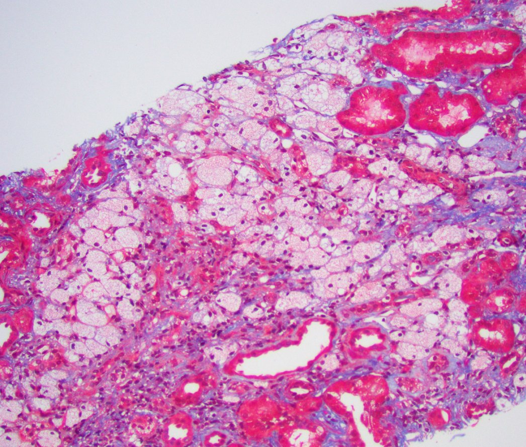JZRenalPath's tweet image. Classic example of Alport spectrum disease in a pt with X-linked Alport syndrome. Lesions of segmental glomerulosclerosis, numerous interstitial foam cells, and atypical GBMs with lamina densa splitting, subepithelial scalloping, and thinning. #renalpath #pathtwitter #nephrology