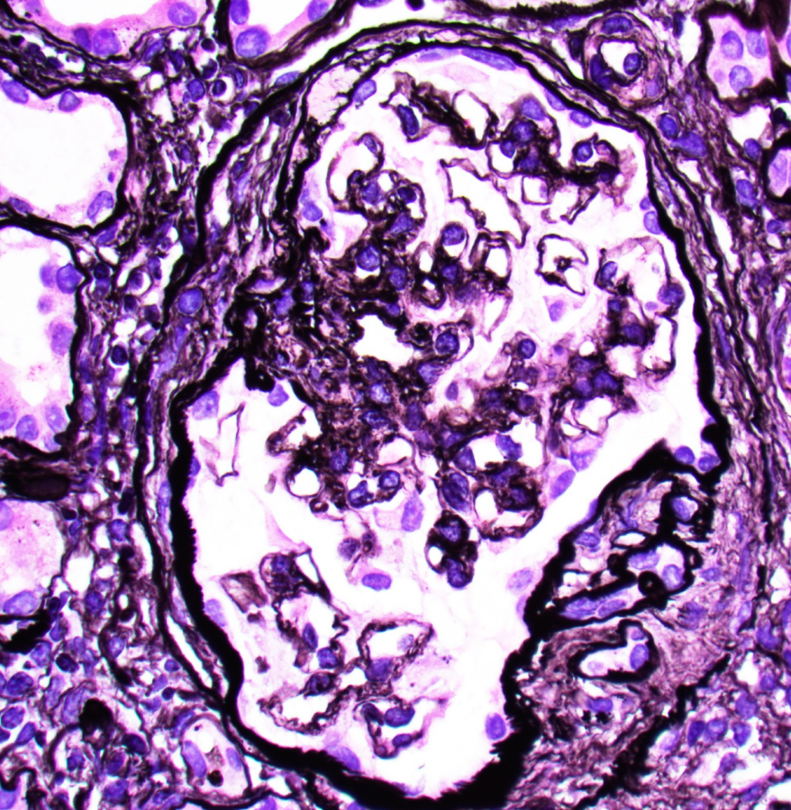 JZRenalPath's tweet image. Classic example of Alport spectrum disease in a pt with X-linked Alport syndrome. Lesions of segmental glomerulosclerosis, numerous interstitial foam cells, and atypical GBMs with lamina densa splitting, subepithelial scalloping, and thinning. #renalpath #pathtwitter #nephrology