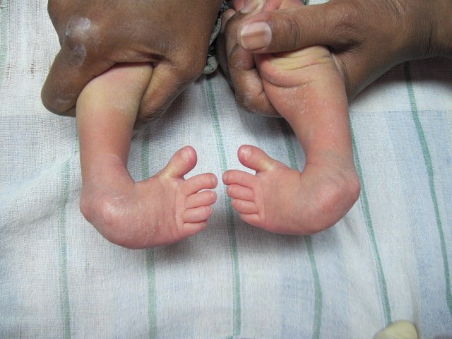 docpawan30's tweet image. CTEV: What No One Talks About

Everyone talks about plaster.
Everyone talks about surgery.
But almost no one talks about what happens after.

Do the boots fit well as the baby grows?

Are the parents able to manage the brace wear time daily?

Is there any hidden stigma affecting…