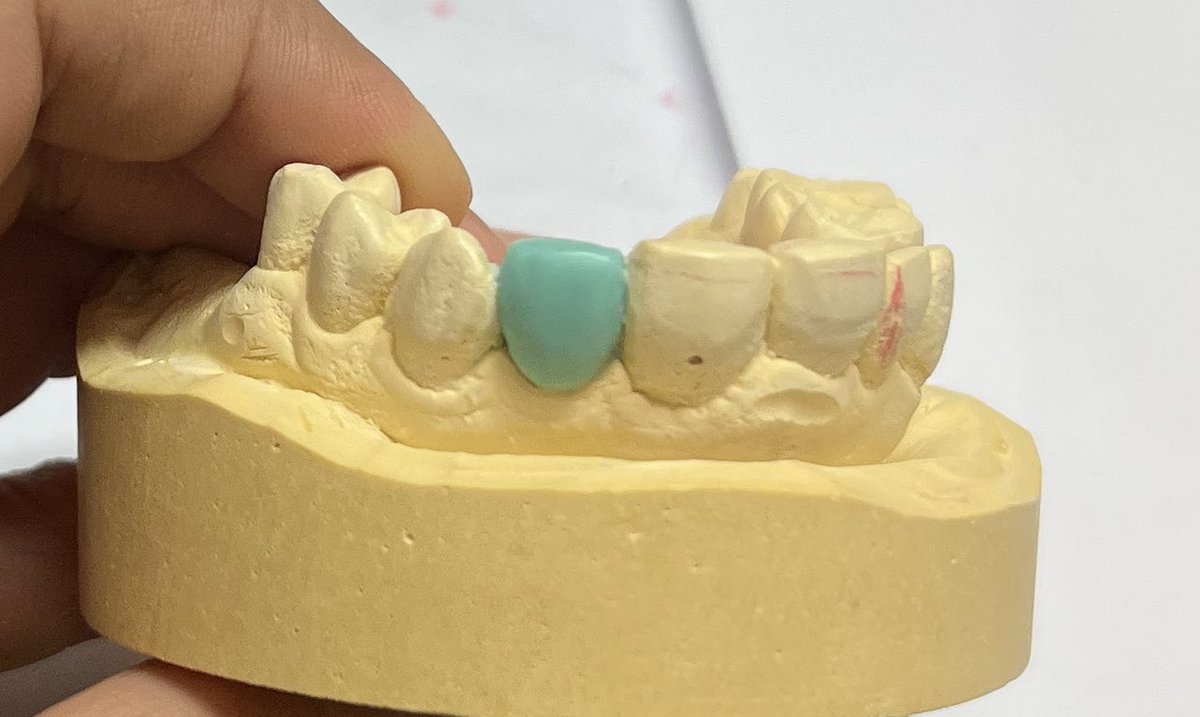 The first patient case, and from here we begin a new story in the internship period.🦷👍🏻