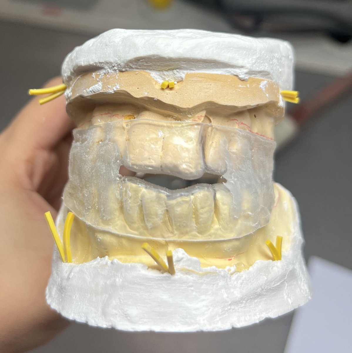 Oral Appliance for Sleep Apnea