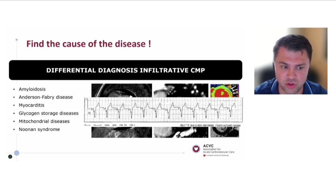 ACVCPresident's tweet image. Excellent webinar on management of #AHF in HFpEF
You can watch the recording on demand at ESC365 @escardio @ann_oleksiak @Sofiegevaert @FH_Verbrugge