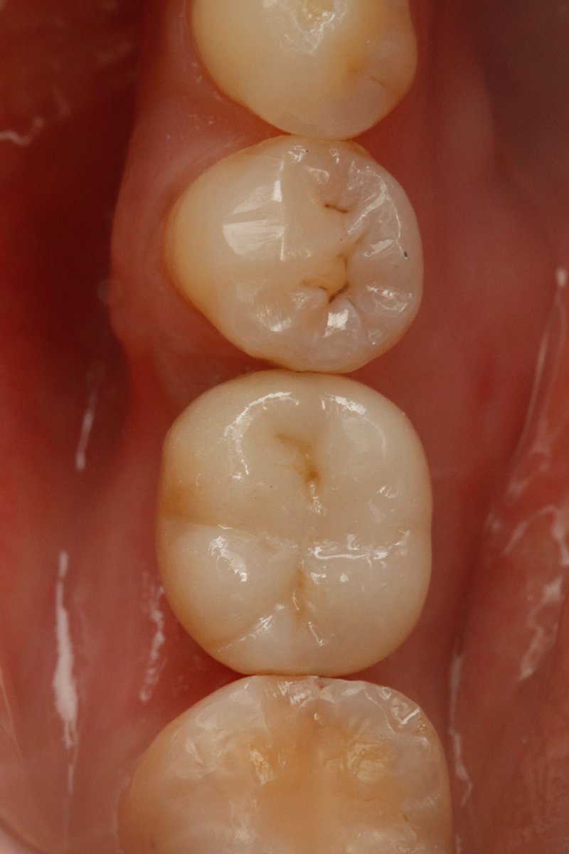 mh5ames's tweet photo. Implant crown https://t.co/cF6UCtkumf