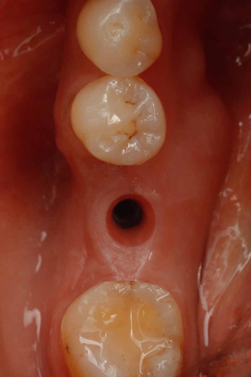 mh5ames's tweet photo. Implant crown https://t.co/cF6UCtkumf
