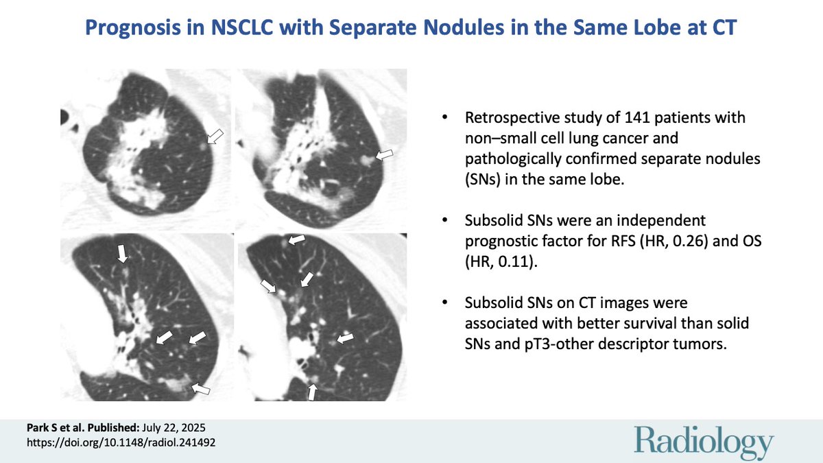 @RadiologyEditor (@radiologyeditor) on Twitter photo Not all lung nodules are created equal š« In this study by <a href="/ChoeMDRad/">Jooae Choe MD PhD</a> et al, subsolid separate nodules in the same lobe meant better outcomes for nonāsmall cell lung cancer than other T3 features. Take a closer look!
pubs.rsna.org/doi/10.1148/ra⦠Not all lung nodules are created equal š« In this study by <a href="/ChoeMDRad/">Jooae Choe MD PhD</a> et al, subsolid separate nodules in the same lobe meant better outcomes for nonāsmall cell lung cancer than other T3 features. Take a closer look!
pubs.rsna.org/doi/10.1148/raā¦