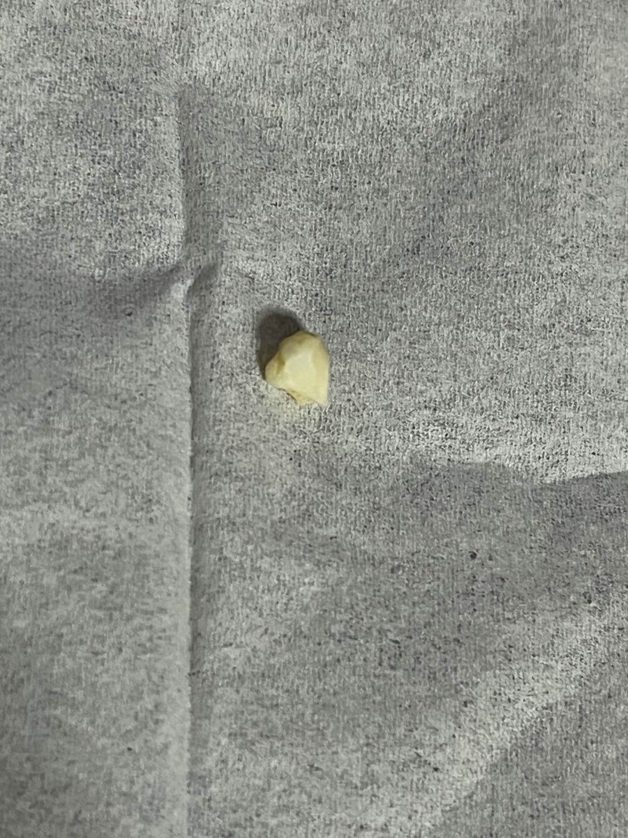 AiconeL's tweet image. 深夜3:40、歯がとれました