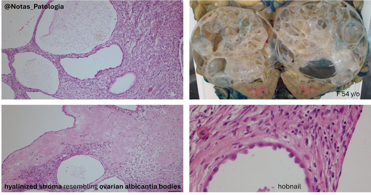 🧠 ADULT CYSTIC NEPHROMA
🩺 A rare, benign renal tumor with distinctive pathological features

Adult cystic nephroma is a benign, multicystic renal neoplasm with a peculiar histogenesis and indolent clinical behavior. It is now considered a distinct entity from pediatric cystic