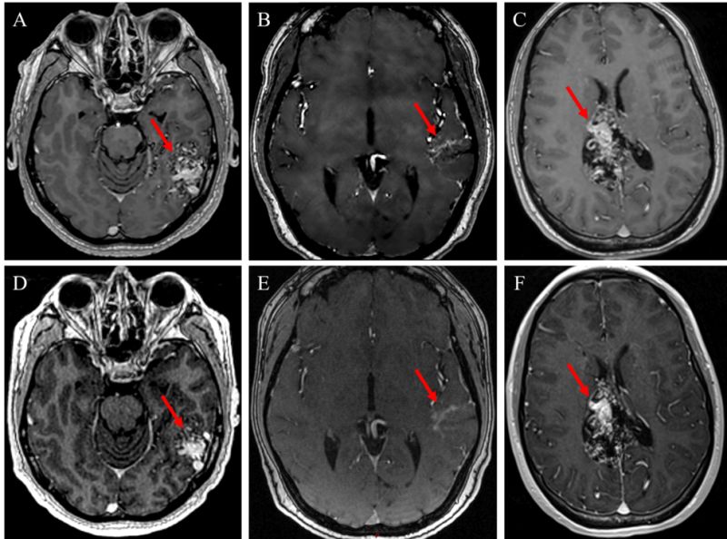 New peer-reviewed case series highlights ZAP-X® as a promising non-invasive AVM treatment, even in high-grade or previously embolized cases.

Explore the full article:cureus.com/articles/37431…

#radiotherapy #roboticsurgery #radiosurgery #neurosurgery #radiotherapy