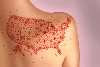 Measles Cases Keep Climbing, Exceeding Long-Term Records  -  jucm.com/measles-cases-…