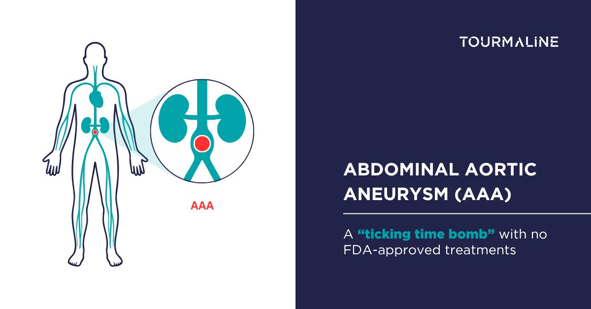 Often called a “ticking time bomb,” abdominal aortic aneurysm (AAA) is a silent but serious threat. If undetected, a AAA can grow unnoticed until it ruptures- an event that is frequently fatal. Despite this, treatment options remain limited. Learn more bit.ly/453FLbp