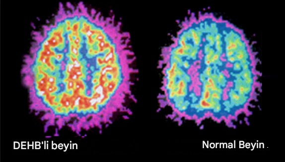 dogalyasalar's tweet photo. ADHD SADECE BİR DİKKAT BOZUKLUĞU DEĞİL…

BİR NÖROKİMYA VE DETOKS SİSTEMİ ÇÖKÜŞÜDÜR.

Glutamat ↗
GABA ↘
Glutatyon ↘
Ağır metal ↗

Peki çözüm?
• GABA desteklemek
• Glutamatı dengelemek
• Detoksu aktive etmek

🧵DETAYLAR THREAD 👇 https://t.co/8E03vYpZfe